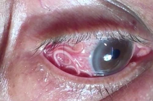 В оці у чоловіка жив 12-сантиметровий гельмінт